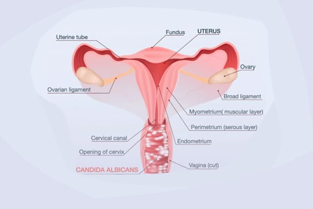 Fungal Vaginitis, Yeast Infection or Candidiasis: How to keep your vagina healthy!