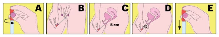 Vulvovaginal Candidias is diagnosed based on the symptoms, a physical examination, and laboratory tests of the vaginal discharge.
